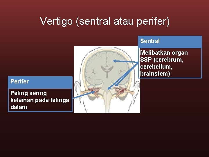 Vertigo (sentral atau perifer) Sentral Melibatkan organ SSP (cerebrum, cerebellum, brainstem) Perifer Peling sering