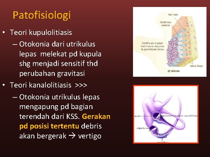 Patofisiologi • Teori kupulolitiasis – Otokonia dari utrikulus lepas melekat pd kupula shg menjadi