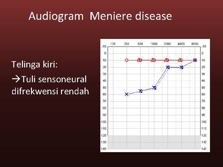 Audiogram Meniere disease Telinga kiri: Tuli sensoneural difrekwensi rendah 
