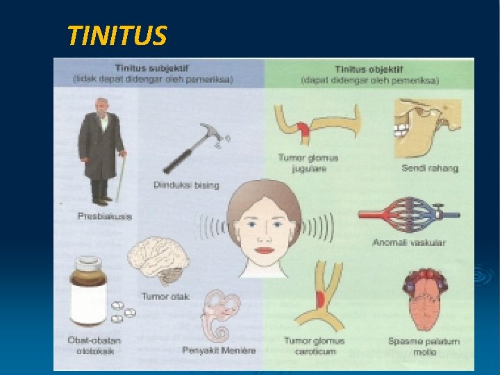 TINITUS 
