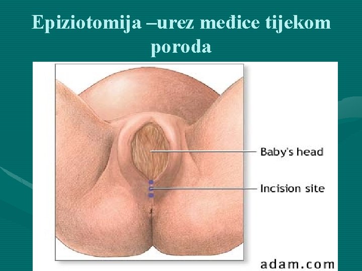 Epiziotomija –urez međice tijekom poroda 