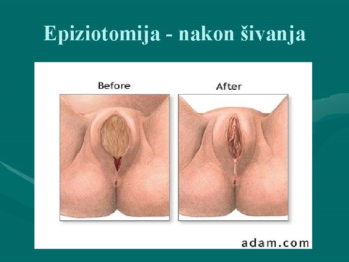 Epiziotomija - nakon šivanja 