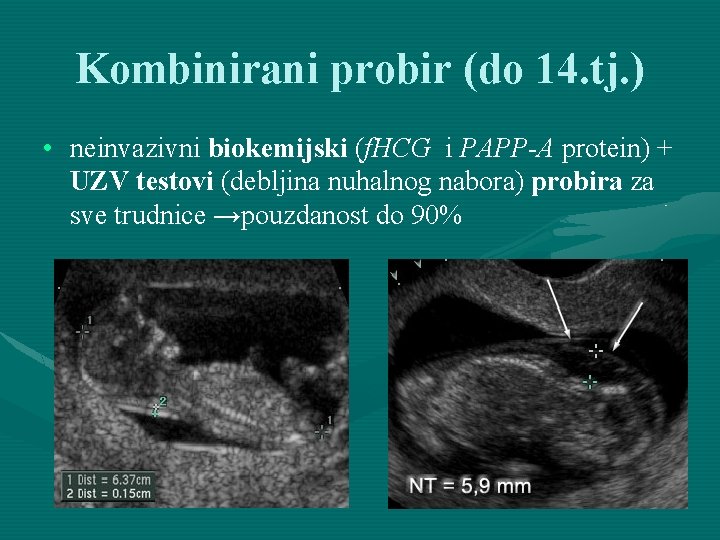 Kombinirani probir (do 14. tj. ) • neinvazivni biokemijski (f. HCG i PAPP-A protein)