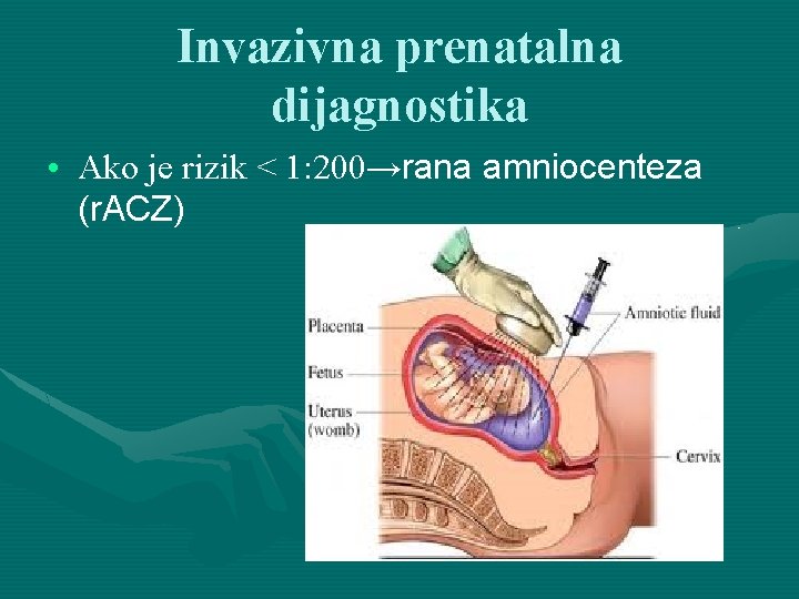 Invazivna prenatalna dijagnostika • Ako je rizik < 1: 200→rana amniocenteza (r. ACZ) 