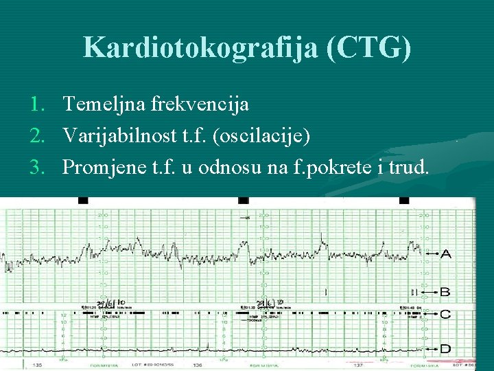 Kardiotokografija (CTG) 1. Temeljna frekvencija 2. Varijabilnost t. f. (oscilacije) 3. Promjene t. f.