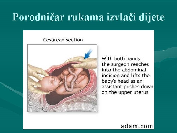 Porodničar rukama izvlači dijete 