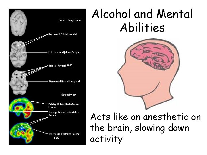 Alcohol and Mental Abilities Acts like an anesthetic on the brain, slowing down activity