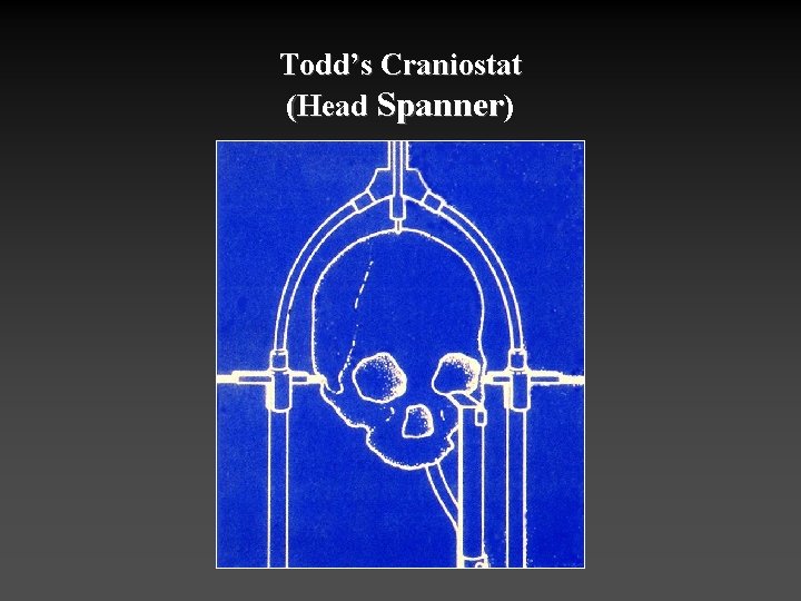 Todd’s Craniostat (Head Spanner) 