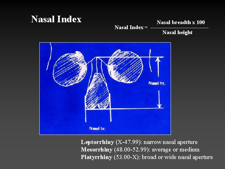 Nasal Index Nasal breadth x 100 Nasal Index = ---------------Nasal height Leptorrhiny (X-47. 99):