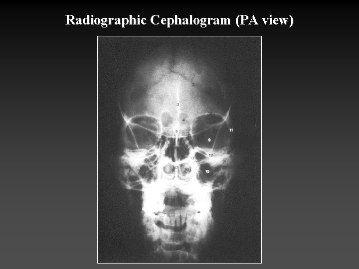 Radiographic Cephalogram (PA view) 