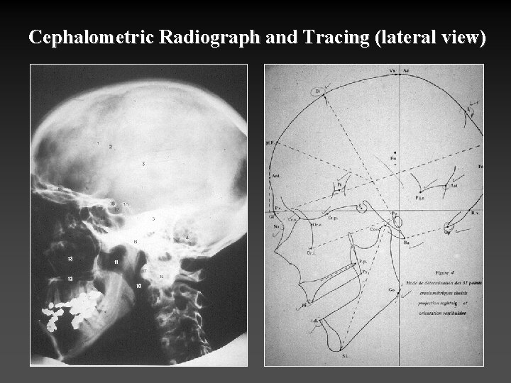 Cephalometric Radiograph and Tracing (lateral view) 