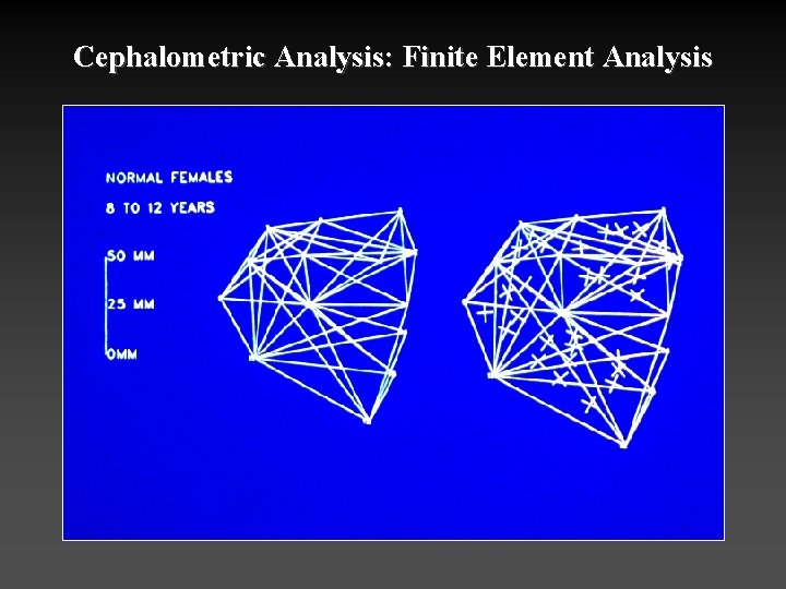 Cephalometric Analysis: Finite Element Analysis 