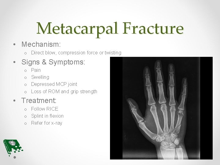 Metacarpal Fracture • Mechanism: o Direct blow, compression force or twisting • Signs &