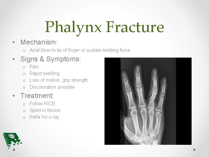 Phalynx Fracture • Mechanism: o Axial blow to tip of finger or sudden twisting