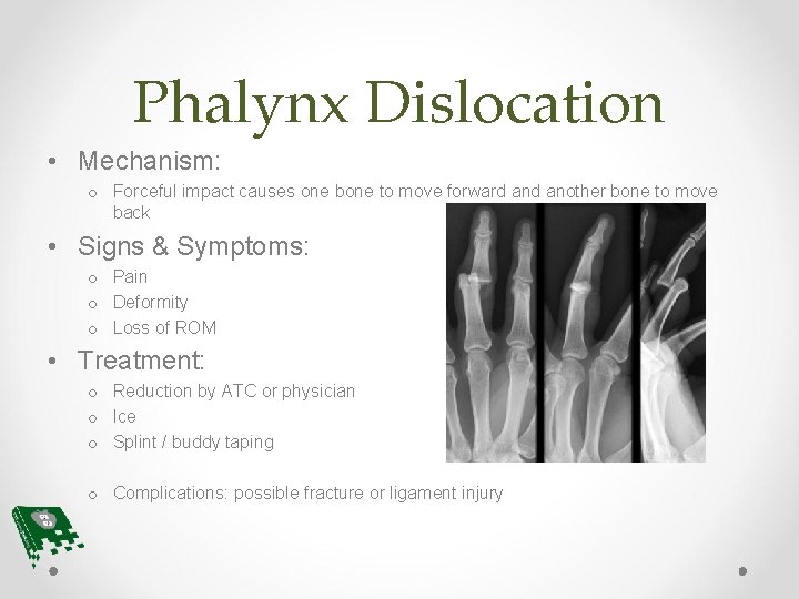 Phalynx Dislocation • Mechanism: o Forceful impact causes one bone to move forward another