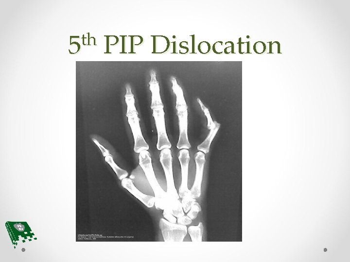 th 5 PIP Dislocation 