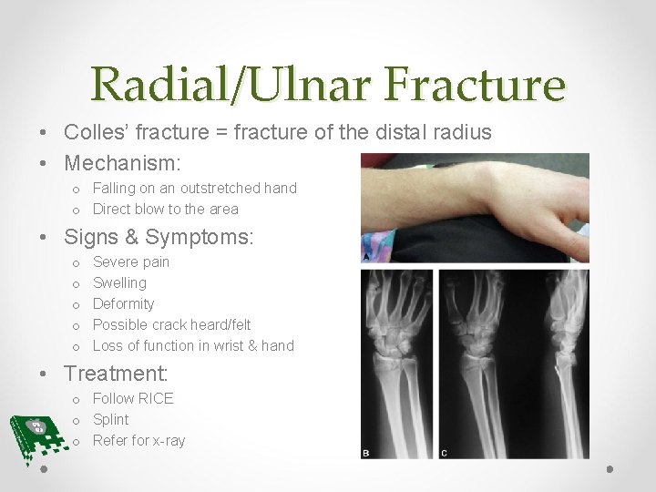 Radial/Ulnar Fracture • Colles’ fracture = fracture of the distal radius • Mechanism: o