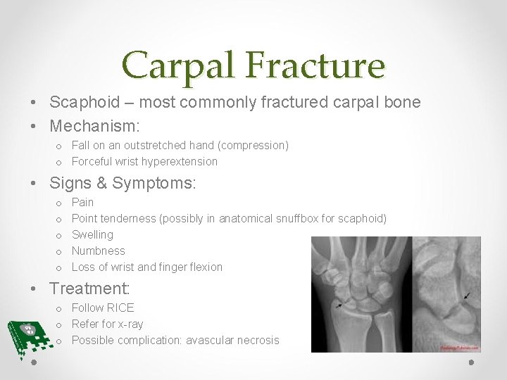 Carpal Fracture • Scaphoid – most commonly fractured carpal bone • Mechanism: o Fall