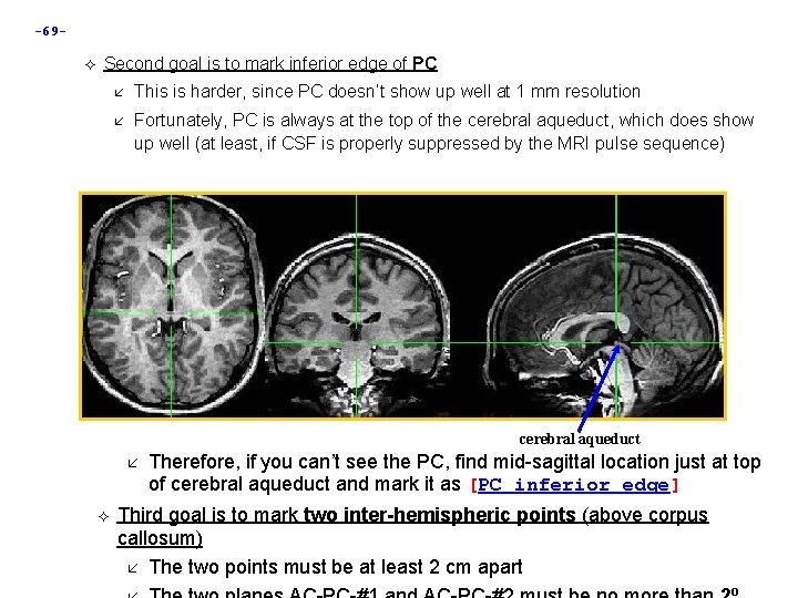 -69 Second goal is to mark inferior edge of PC This is harder, since