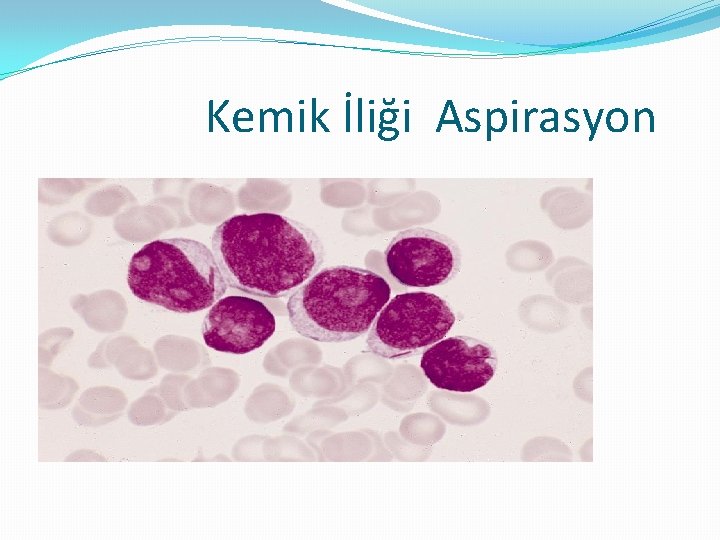 Kemik İliği Aspirasyon 