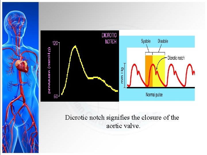 Dicrotic notch signifies the closure of the aortic valve. 