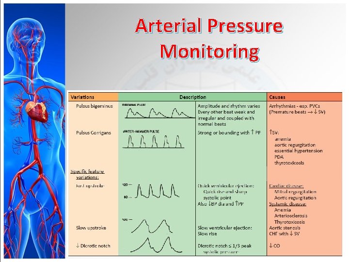 Arterial Pressure Monitoring 