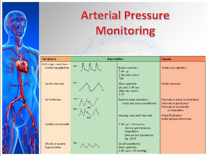 Arterial Pressure Monitoring 