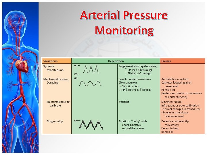 Arterial Pressure Monitoring 
