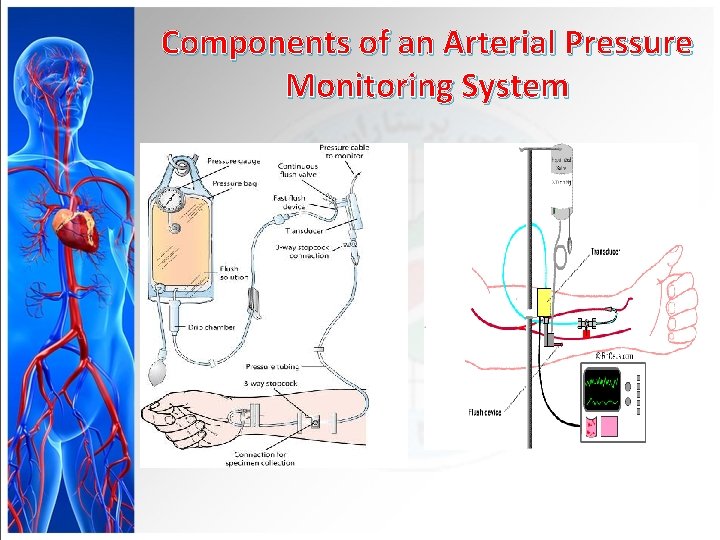 Components of an Arterial Pressure Monitoring System 