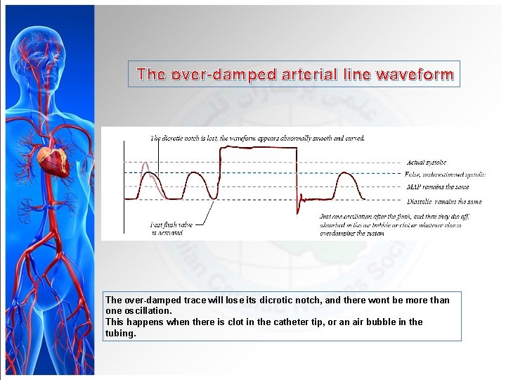 The over-damped arterial line waveform The over-damped trace will lose its dicrotic notch, and