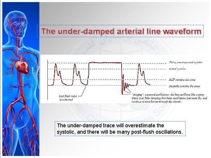 The under-damped arterial line waveform The under-damped trace will overestimate the systolic, and there