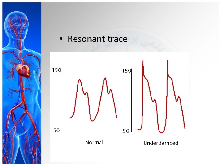  • Resonant trace 