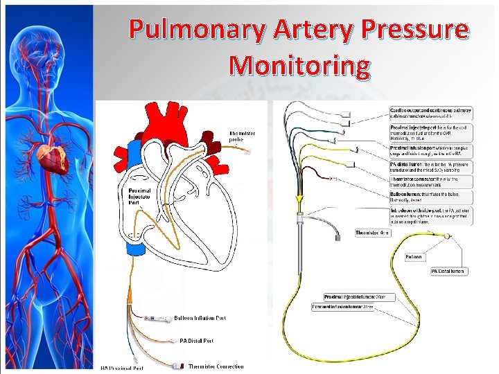 Pulmonary Artery Pressure Monitoring 