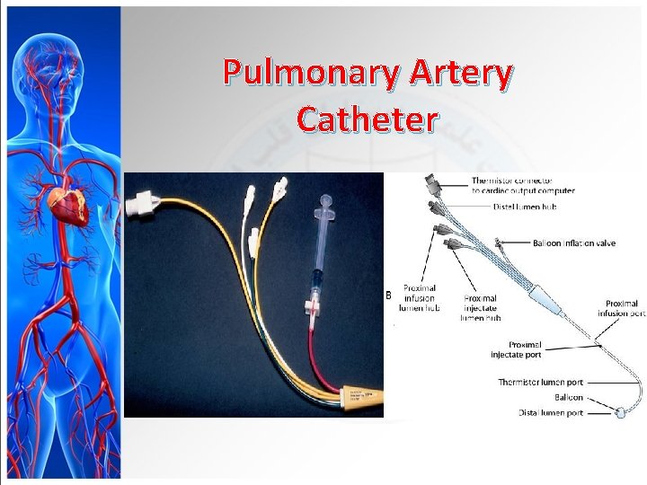 Pulmonary Artery Catheter 