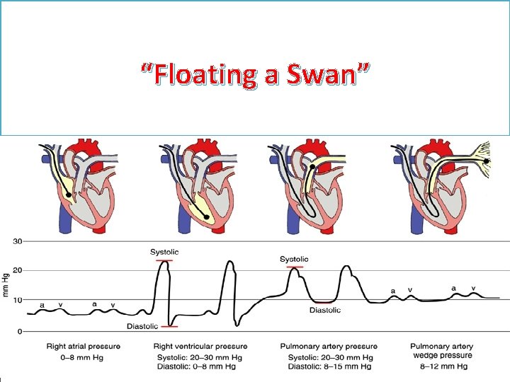 “Floating a Swan” 