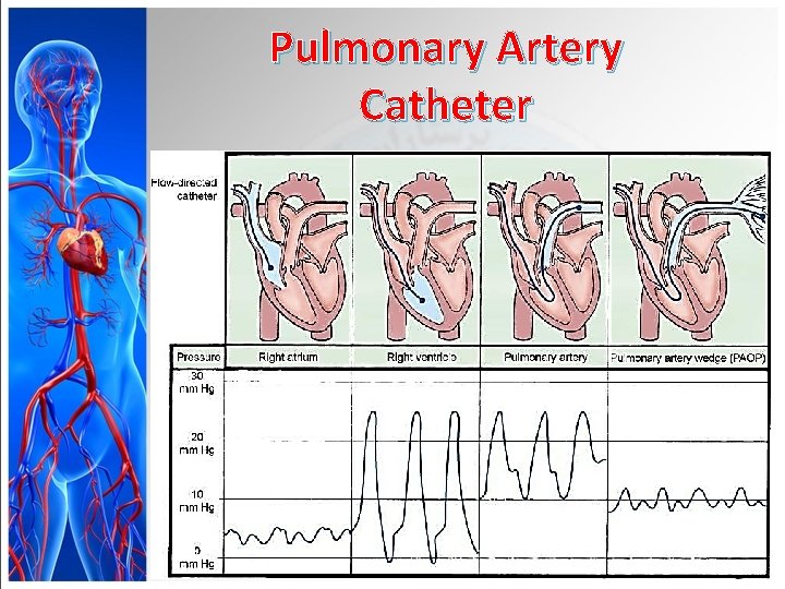 Pulmonary Artery Catheter 