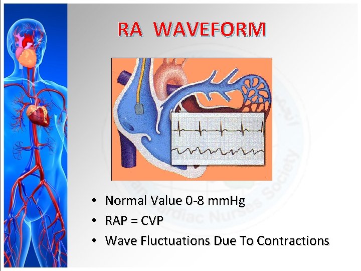 RA WAVEFORM • • • Normal Value 0 -8 mm. Hg RAP = CVP