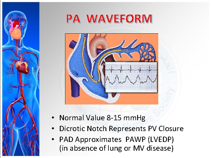 PA WAVEFORM • Normal Value 8 -15 mm. Hg • Dicrotic Notch Represents PV