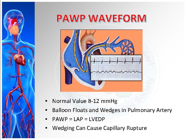 PAWP WAVEFORM • • Normal Value 8 -12 mm. Hg Balloon Floats and Wedges