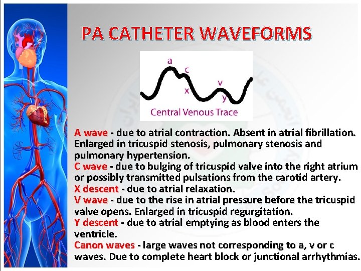 PA CATHETER WAVEFORMS A wave - due to atrial contraction. Absent in atrial fibrillation.