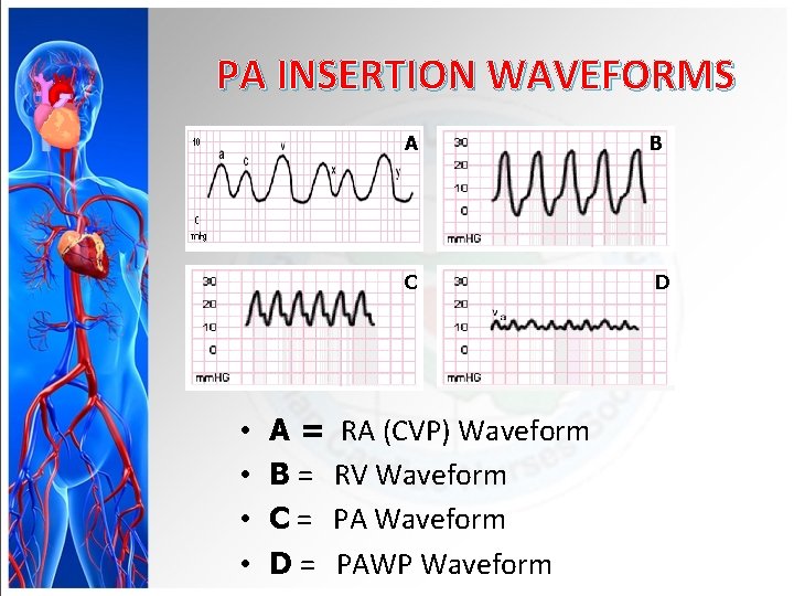 PA INSERTION WAVEFORMS • • A B C D A = RA (CVP) Waveform