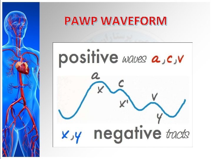 PAWP WAVEFORM 