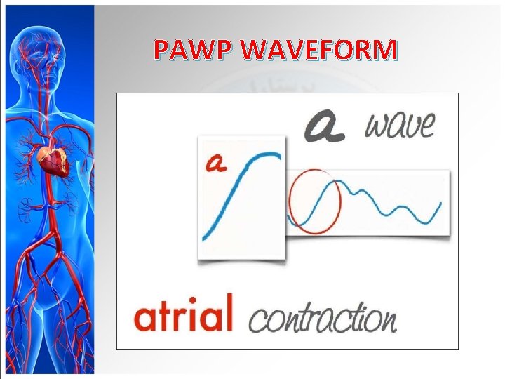 PAWP WAVEFORM 