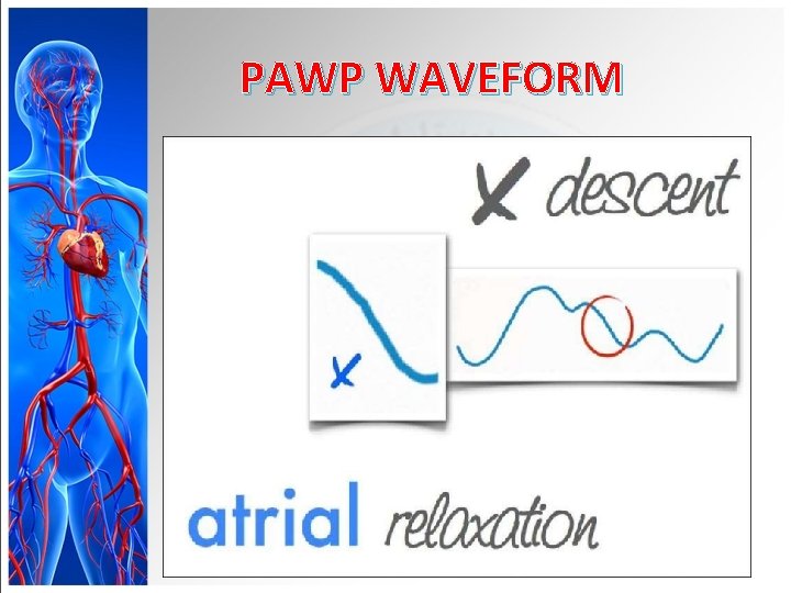 PAWP WAVEFORM 