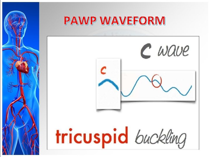 PAWP WAVEFORM 