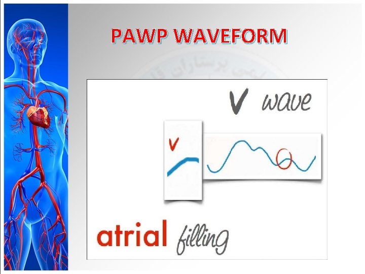 PAWP WAVEFORM 