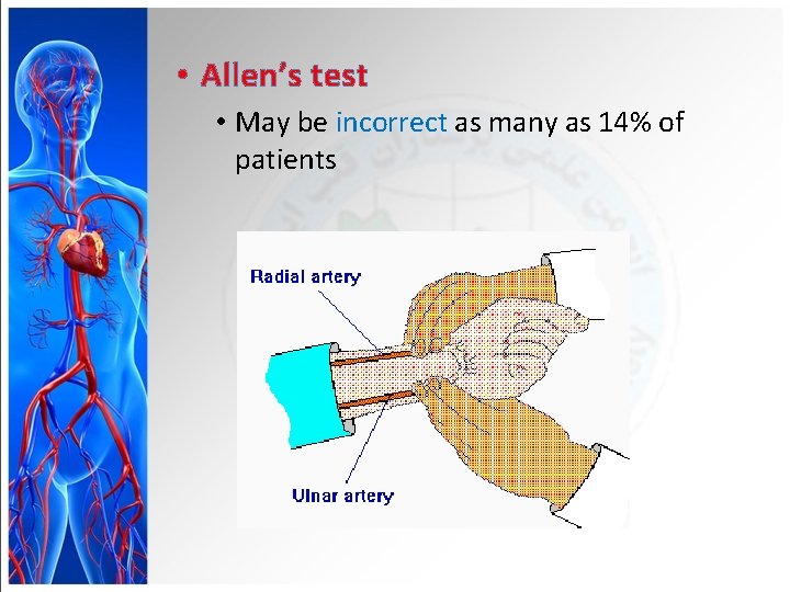  • Allen’s test • May be incorrect as many as 14% of patients