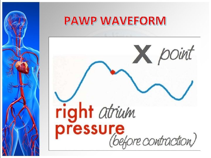 PAWP WAVEFORM 