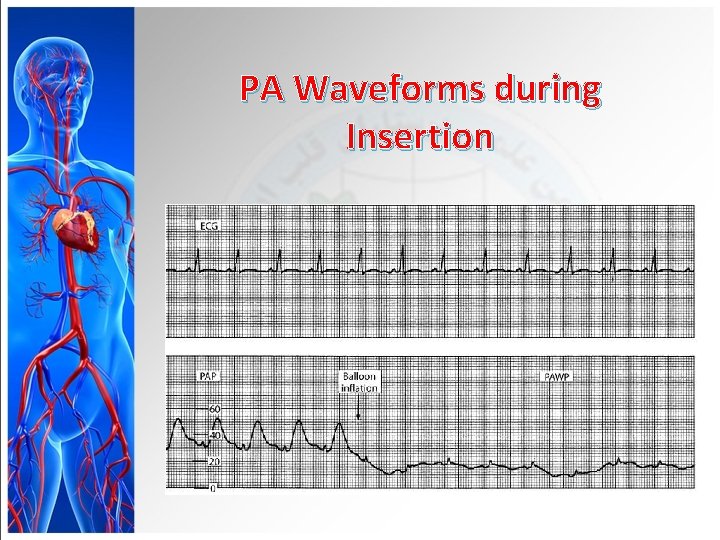 PA Waveforms during Insertion 