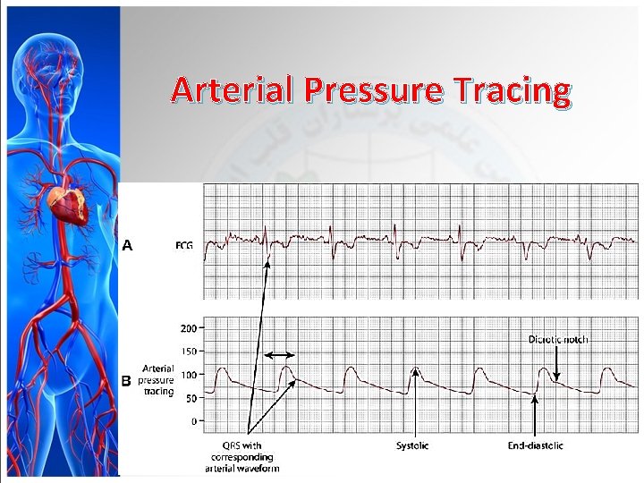 Arterial Pressure Tracing 